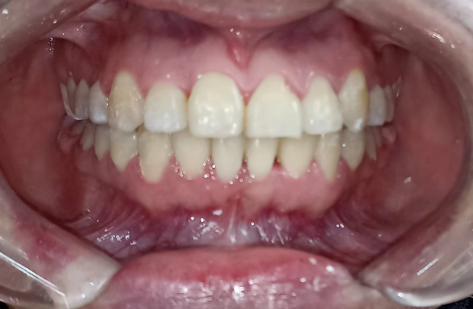 Después del tratamiento de Karina